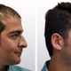 Illustration for article titled Hair Transplant in Islamabad